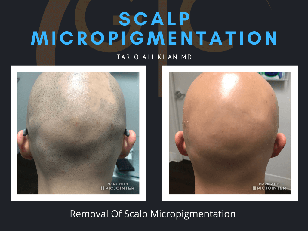 Gentle Care Laser Tustin & Long Beach Before and After picture - Scalp micropigmentation